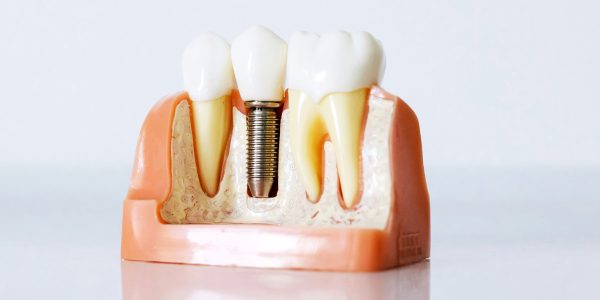 clinica-dental-arfelis-implantes-dentales.jpg