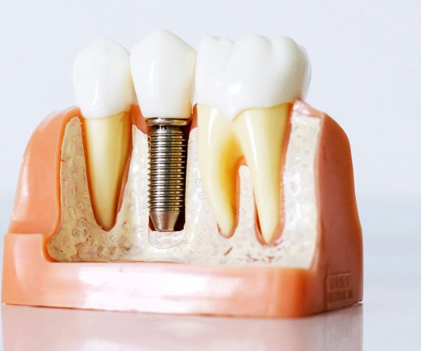 clinica-dental-arfelis-implantes-dentales.jpg